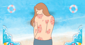 건선 아토피 감별법